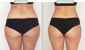 GEL LIPOREDUCTOR